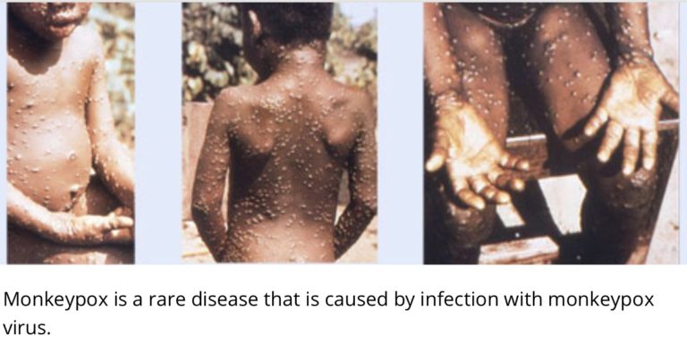 Monkeypox: Biden says ‘everybody’ should be concerned