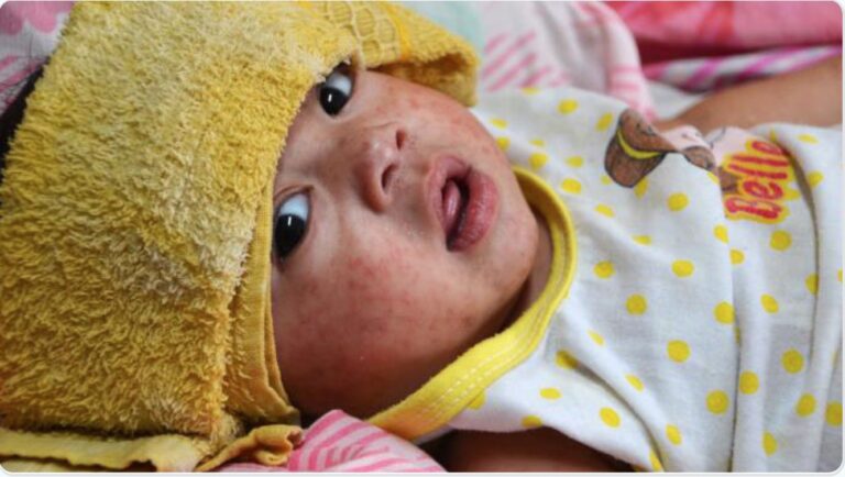 Measles spotted in Anchorage